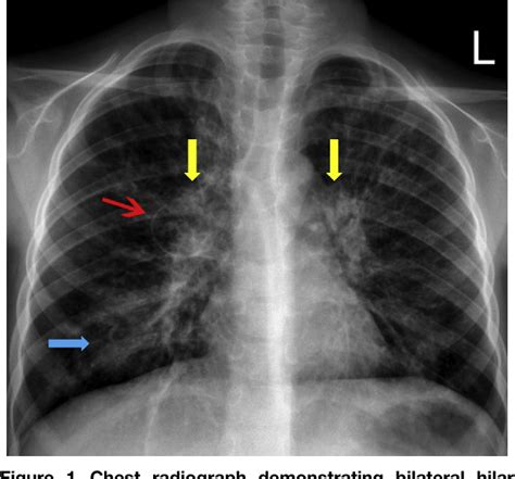 x ray for asthma|Chest X.